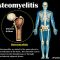 OSTEOMYELITIS: A Cause of Bone Pain