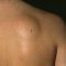 LIPOMA: What do you know about it?