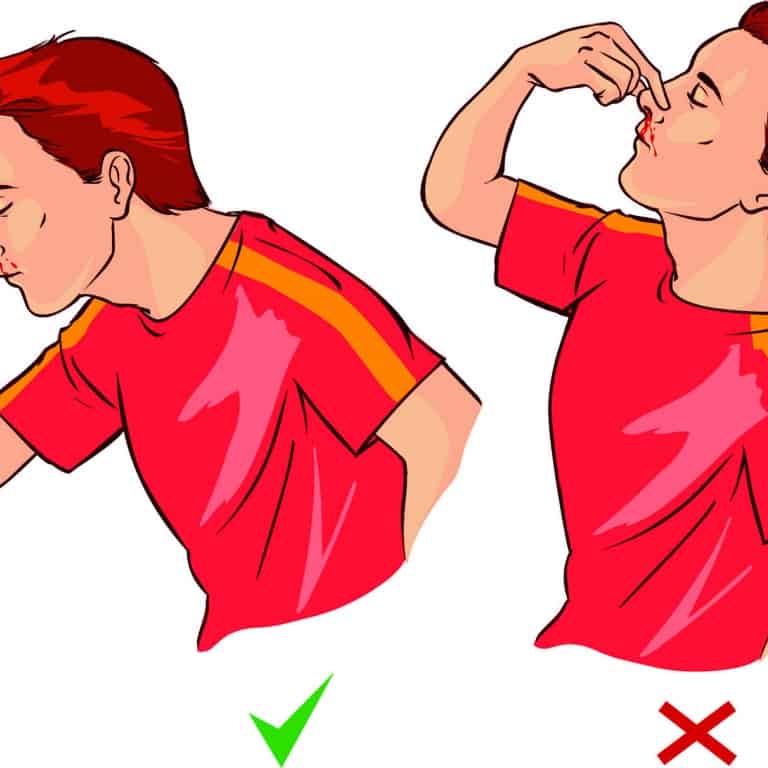 HOW TO STOP NOSEBLEED AT HOME HealthGist Net