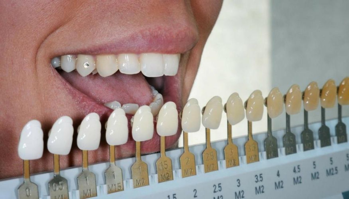 WHAT DOES THE COLOUR OF YOUR TEETH HAVE TO SAY ABOUT YOU HealthGist Net