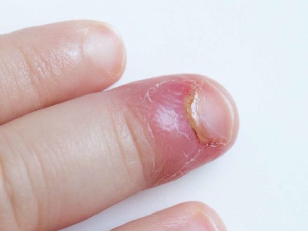 WHY DOES MY FINGERNAIL HURT ON THE SIDE HealthGist Net