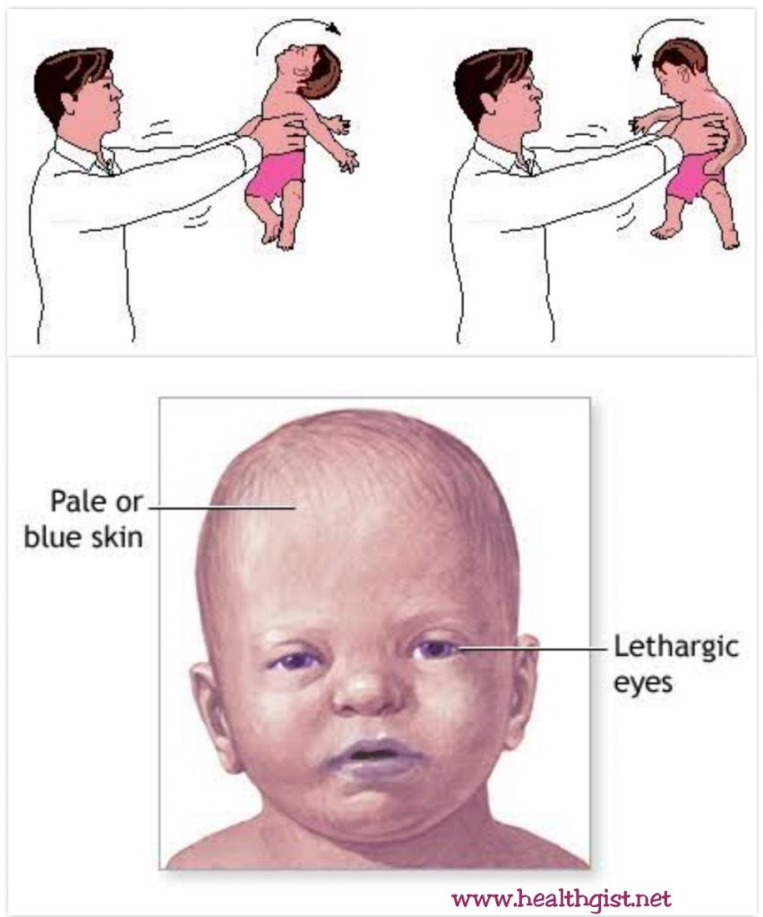 Shaken Baby Syndrome | HealthGist.Net