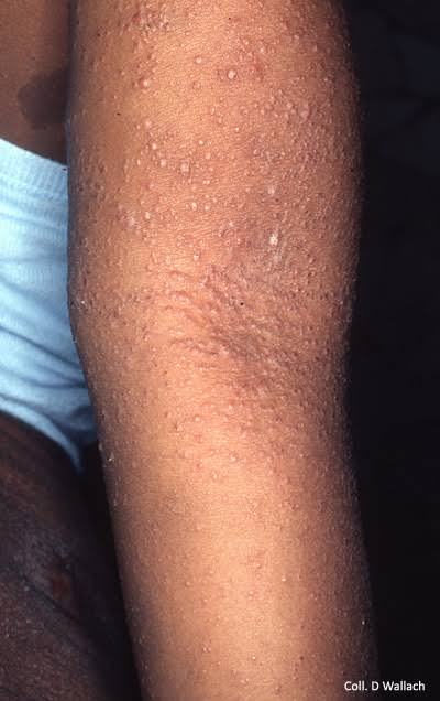 ATOPIC DERMATITIS: Skin disease you'll not want to experience...